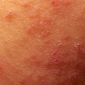 atopic dermatitis picture