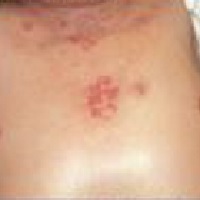 dermatitis on the chest picture