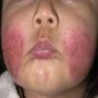 dermatitis on face picture